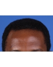 After Hair Transplant &nbsp;Front